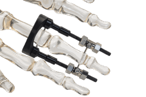 FIX22Ligamentotaxis_max_250KB