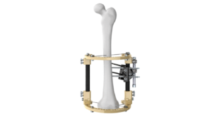FIXUS_dual_rod_transparent_max_250KB