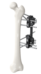femur_fixator_transparent_max200kb