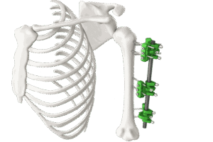 fixator_humerus_max_250KB