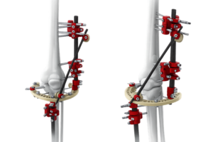 knee_hybrid_transparent_max_200KB