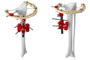 prox_tibia_transparent_max_250KB